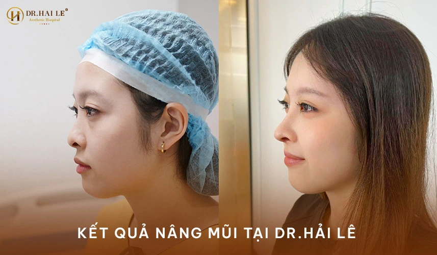 Khách hàng hài lòng với dáng nâng mũi tại bệnh viện tạo hình thẩm mỹ Dr.Hải Lê