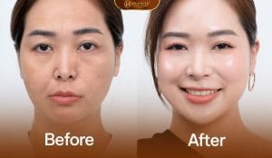 Ảnh trước sau khi khách hàng thực hiện tổ họp medi-rba