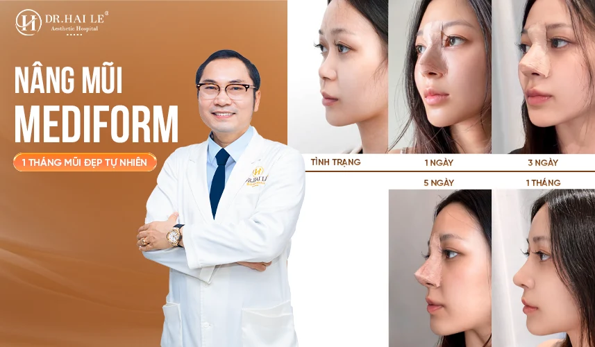 Các dáng mũi nữ đẹp chuẩn y khoa là sự kết hợp tổng hòa giữa độ cao sống mũi, góc chiếu của đầu mũi