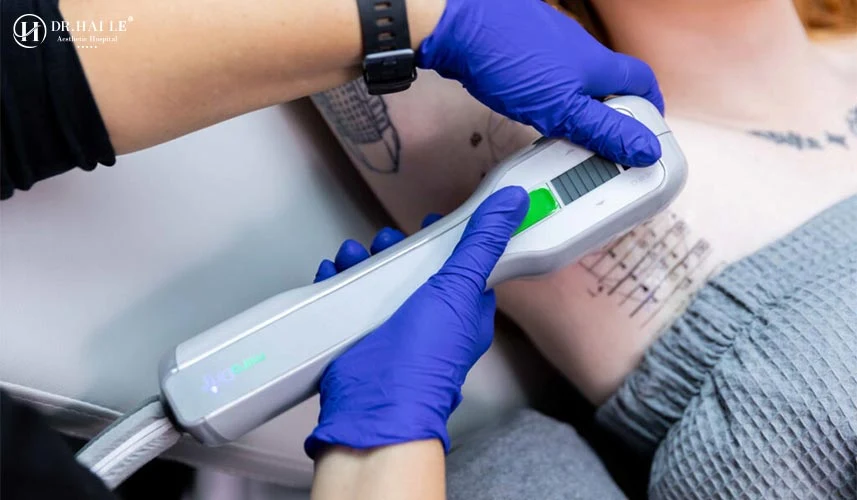 Trị hôi nách MiraDry là phương pháp điều trị chứng tăng tiết mồ hôi (Hyperhidrosis) và mùi hôi cơ thể (Bromhidrosis)