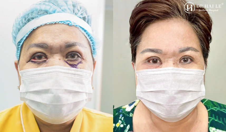 Cắt sửa mí mắt ở Dr.Hải Lê có tốt không? 3 Cắt sửa mí mắt ở Dr Hải Lê có tốt không là nỗi trăn trở của hàng ngàn bệnh nhân khi không may gặp sự cố thẩm mỹ mắt hỏng