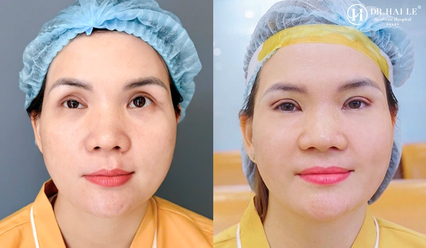 Cắt sửa mí mắt ở Dr.Hải Lê có tốt không? 5 Một ca sửa mí được tiến hành tuân thủ nghiêm ngặt theo chuẩn mực y khoa 5 bước khép kín của Bộ Y tế