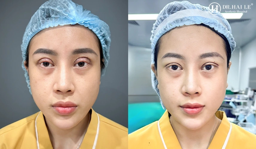 Cắt sửa mí mắt ở Dr.Hải Lê có tốt không? 7 Cắt sửa mí mắt tại Bệnh viện Tạo hình Thẩm mỹ Dr.Hải Lê là bạn đang trao gửi niềm tin đúng chỗ cho một thương hiệu thẩm mỹ