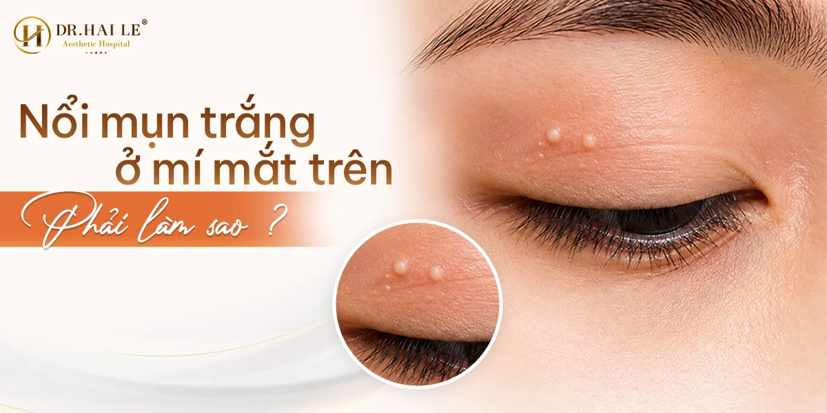 Chuyên gia giải đáp: Nổi mụn trắng ở mí mắt trên phải làm sao?