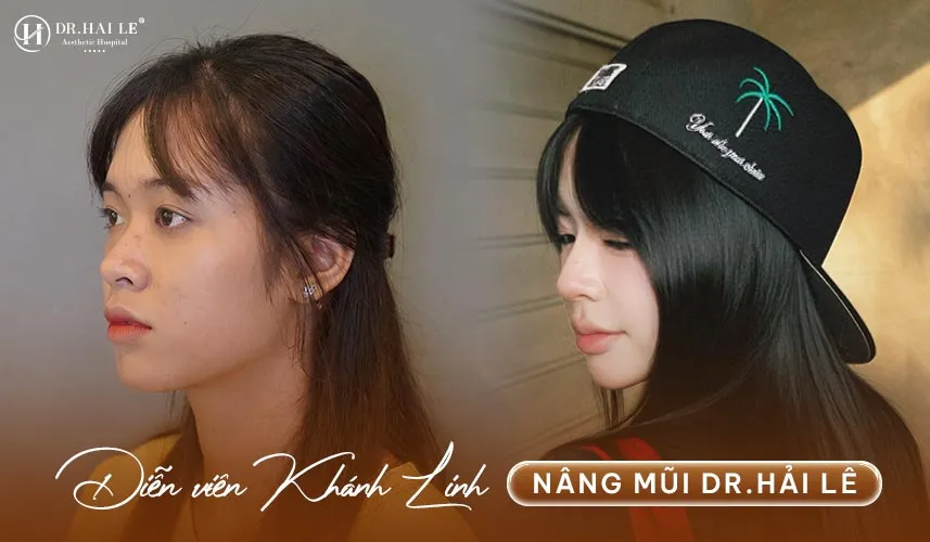 Bệnh viện Tạo hình Thẩm mỹ Dr.Hải Lê cam kết mang lại giải pháp nâng mũi Demi Tech 6D chuẩn y khoa