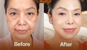 Cải thiện nét trẻ trung toán diện với tổ hợp medi rba