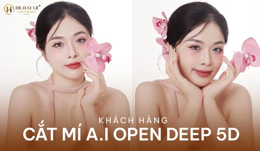 Review cắt mí tại Dr.Hải Lê cung cấp góc nhìn thực tế và y khoa toàn diện về phương pháp tiểu phẫu tạo hình nếp mí mắt