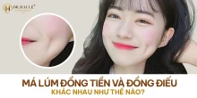 Phân biệt giữa má lúm đồng tiền và đồng điếu