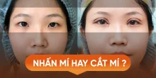 Nên nhấn mí hay cắt mí Dr.Hải Lê?