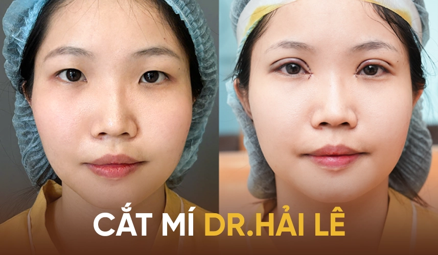 Quy trình phẫu thuật vô khuẩn khép kín nghiêm ngặt theo đúng tiêu chuẩn kiểm định của Bộ Y tế