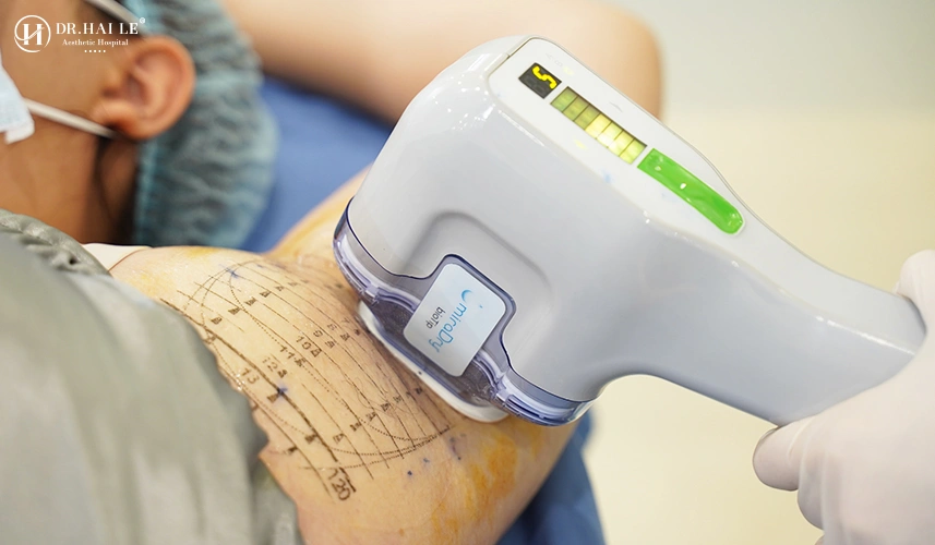 Trị hôi nách MiraDry giá bao nhiêu phụ thuộc vào phác đồ cá nhân hóa, mức độ gia tăng tiết mồ hôi và tình trạng vi khuẩn vùng dưới cánh tay của từng bệnh nhân