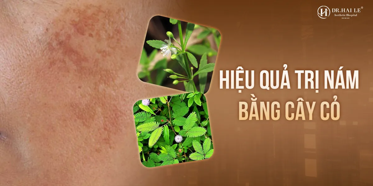 Cách trị nám bằng cây cỏ mang lại hiệu quả