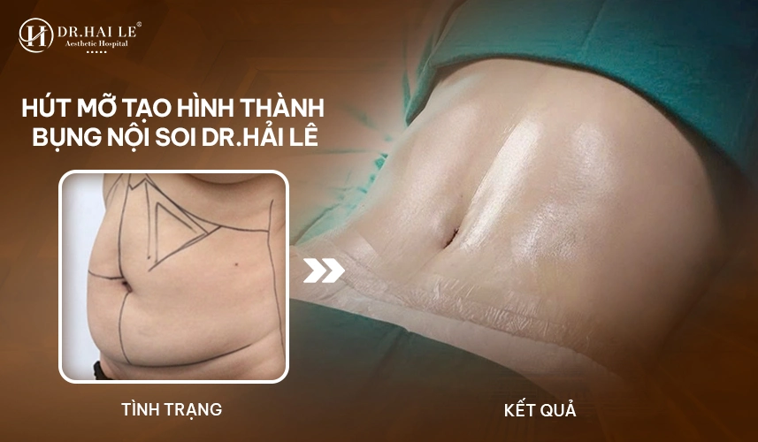 Hút mỡ Tạo hình thành bụng giúp da bụng săn chắc, giảm rõ rệt tình trạng nhăn – rạn