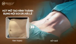 Hút mỡ tạo hình thành bụng được thực hiện bằng công nghệ nội soi
