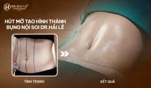 Hút mỡ nội soi tạo hình thành bụng mang lại hiệu quả