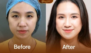Khách hàng sau khi cắt mí AI matrix deep tại Dr.Hải Lê