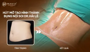 Kỹ thuật hút mỡ tạo hình thành bụng nội soi tại Dr.Hải Lê