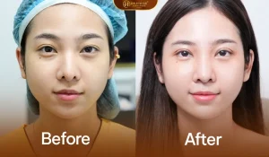 Thay đổi nếp mí với phương pháp cắt mí AI matrix deep