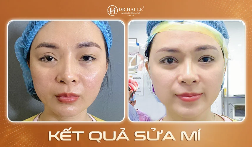 Kết quả sửa mí Deep Tech tại Dr.Hải Lê