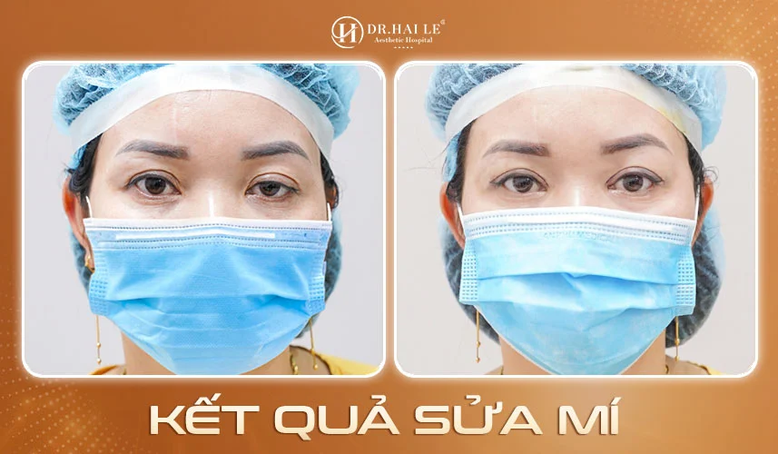 Khôi phục mắt hỏng bằng sửa mí Deep Tech