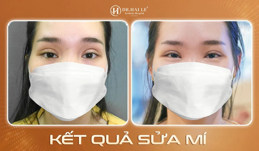 Hình ảnh khách hàng sửa mí thành công tại Dr.Hải Lê