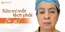 Bí quyết sở hữu đôi mắt cân đối nhờ sửa mí mắt lệch phải?