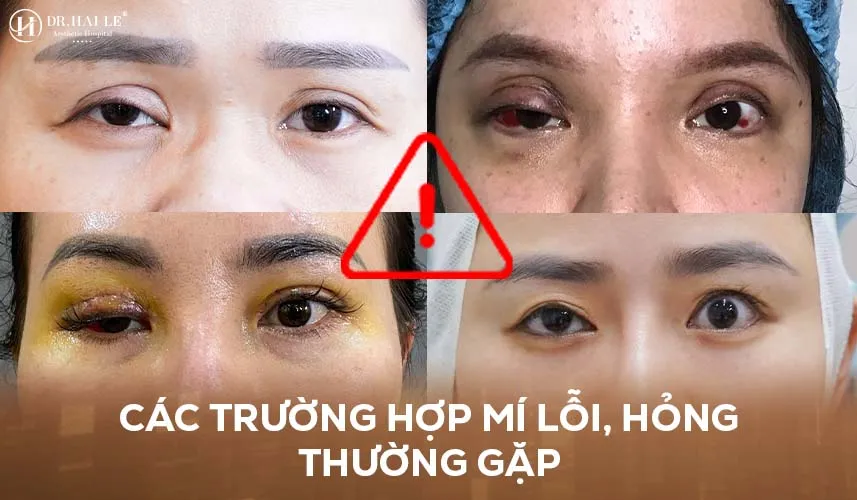 Chuyên gia cảnh báo những trường hợp cắt mí hỏng 4 Các trường hợp cắt mí bị hỏng thường gặp cần can thiệp sớm