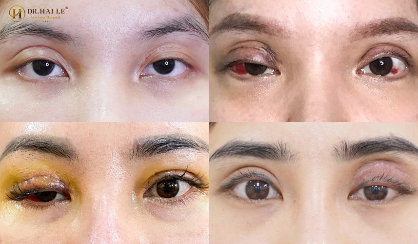 Phân loại các dạng cắt mí lỗi hỏng
