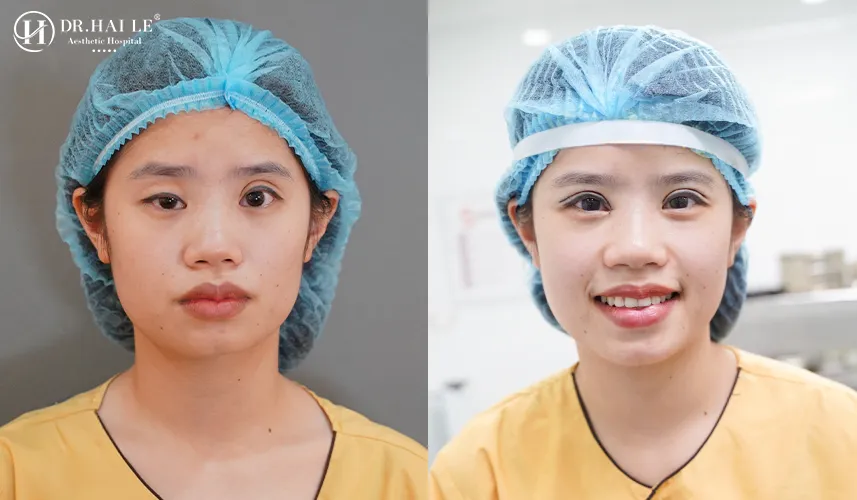 Cách sửa mí mắt bị sụp Dr Hải Lê
