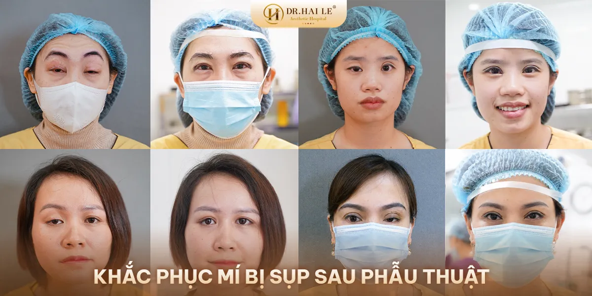 Bật mí cách sửa mí mắt bị sụp hiệu quả?