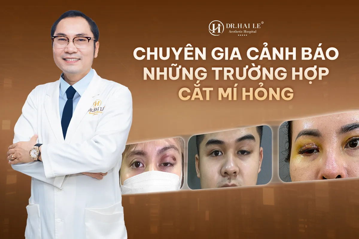 Chuyên gia cảnh báo những trường hợp cắt mí hỏng 1 Chuyên gia cảnh báo những trường hợp cắt mí hỏng?