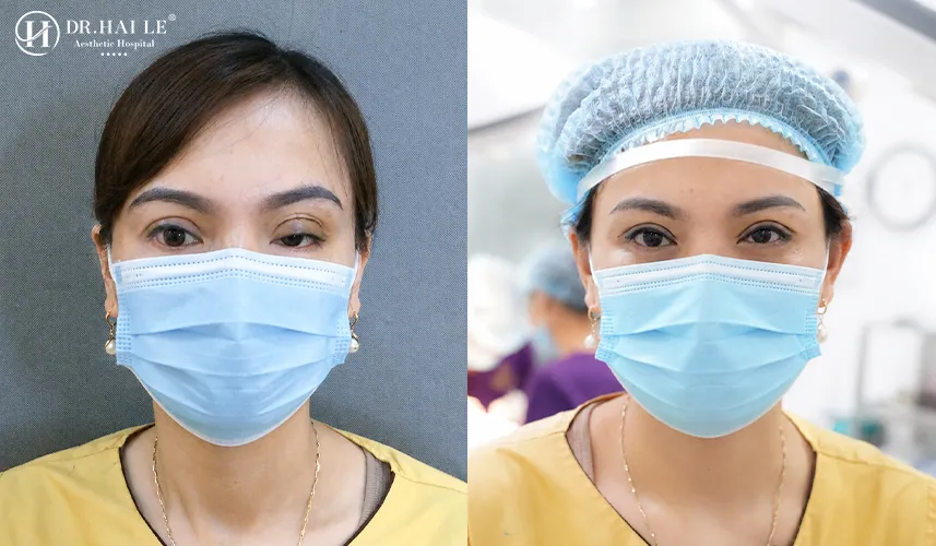 Cắt mí hỏng bao lâu sửa lại được Dr Hải Lê