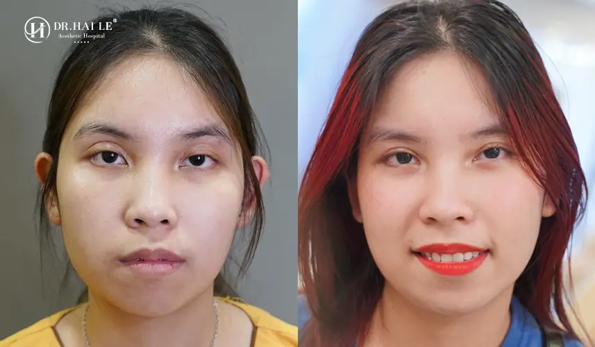 Kết quả sửa mí tại Dr.Hải Lê