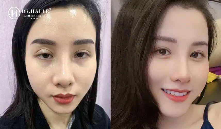 Cắt mí hỏng có sửa được không tại Dr.Hải Lê
