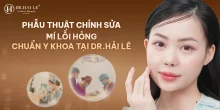 Phẫu thuật chỉnh sửa mí lỗi hỏng?