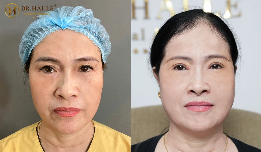 Theo các báo cáo y khoa hiện đại, mí mắt sở hữu cấu trúc vô cùng mỏng manh, phức tạp với nhiều lớp đan xen