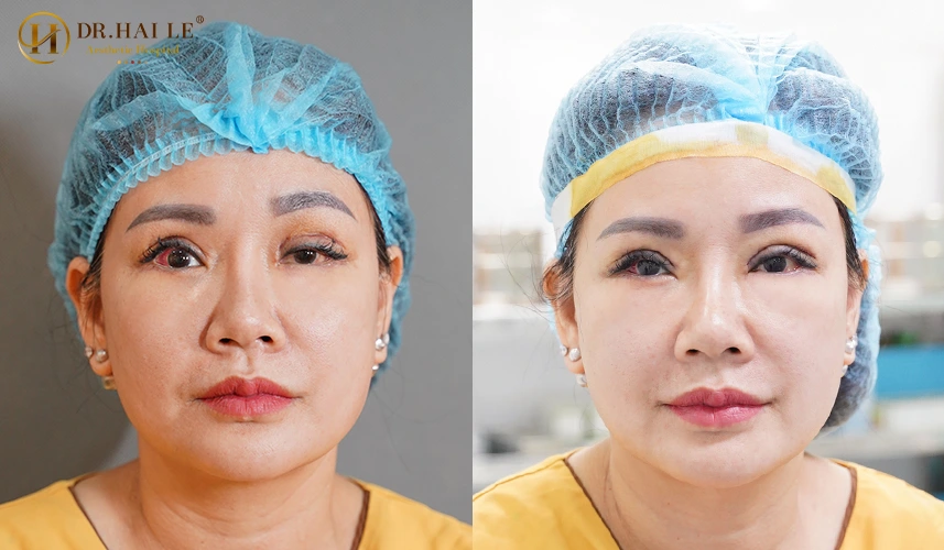Mọi ca can thiệp sửa mí lỗi hỏng tại Dr.Hải Lê đều phải trải qua quy trình SOP (Standard Operating Procedure) khép kín, được cấp phép và thẩm định khắt khe bởi Bộ Y tế