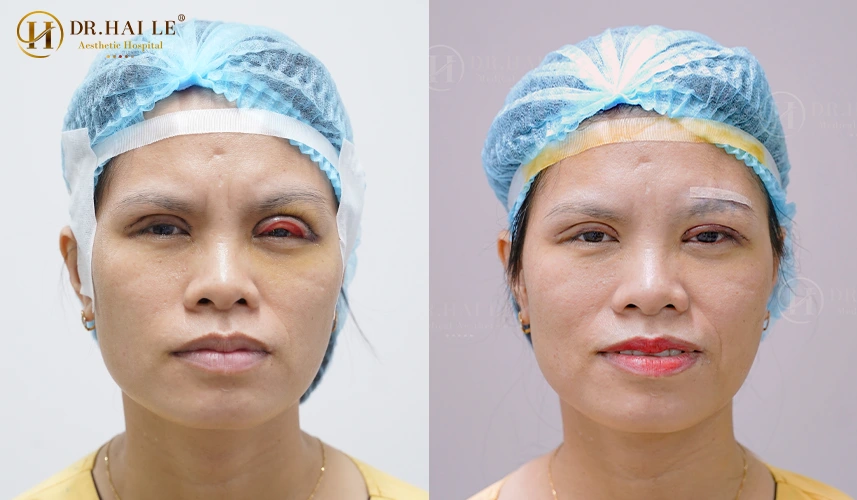 Khắc phục biến chứng mí hỏng không chỉ là việc chữa lành các tổn thương y khoa, mà còn là hành trình vĩ đại tìm lại sự kiêu hãnh và giá trị bản thân