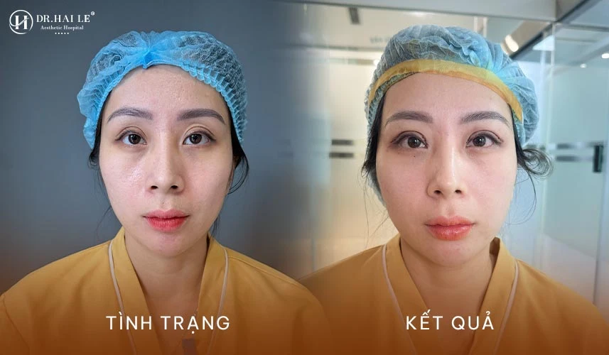 Có nên sửa mí mắt không đều sau phẫu thuật? 3 Sửa mí mắt không đều sau phẫu thuật là một kỹ thuật chỉnh sửa thẩm mỹ mắt chuyên sâu