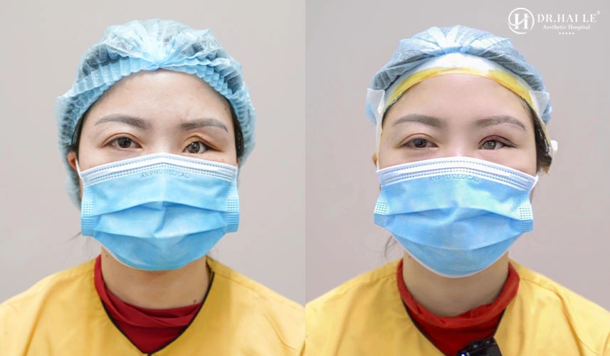 Kết quả phục hồi ca mí hỏng trợn tại Dr.Hải Lê