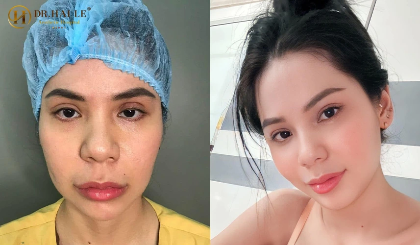 Sửa mí mắt chất lượng là một thủ thuật phẫu thuật vi phẫu phức tạp, được thiết kế chuyên biệt để khắc phục