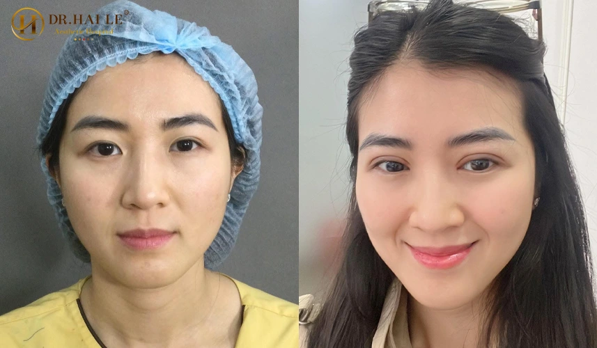 Bác sĩ Hải Lê áp dụng đúng phương pháp sửa mí mắt chất lượng tương ứng, đảm bảo tính an toàn tuyệt đối