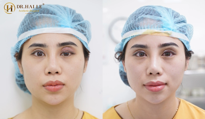 Những sai lầm kinh điển khiến tình trạng mí lỗi trở nên tồi tệ hơn, đồng thời đưa ra những lời khuyên y khoa chuẩn mực