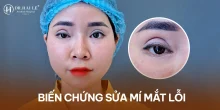 Dr.Hải Lê - Tư vấn miễn phí giải pháp sửa mí mắt lỗi?