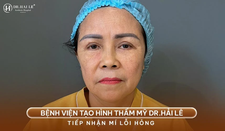 Sửa mí mắt lỗi là kỹ thuật can thiệp ngoại khoa vi phẫu nhằm bóc tách toàn bộ tổ chức sẹo xơ cứng cũ, định hình lại cơ nâng mi