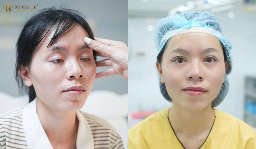 Giải pháp khắc phục đôi mắt bị hỏng an toàn tại Dr.Hải Lê