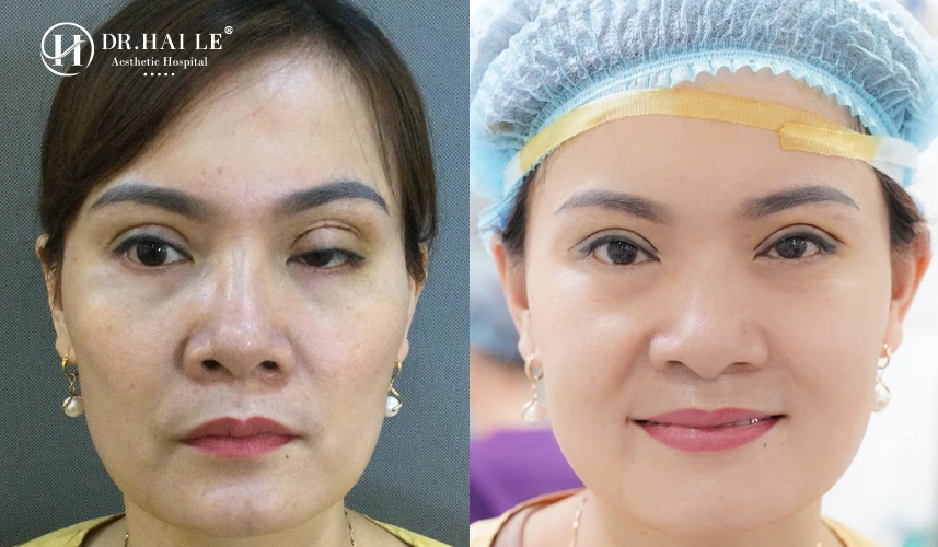 Giải pháp sửa cắt mí bị hư chuẩn y khoa tại Bệnh viện Dr.Hải Lê