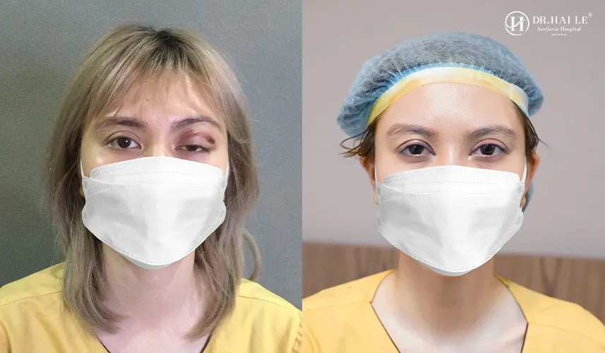 Giải pháp xử lý mí mắt bị lệch và trũng sâu