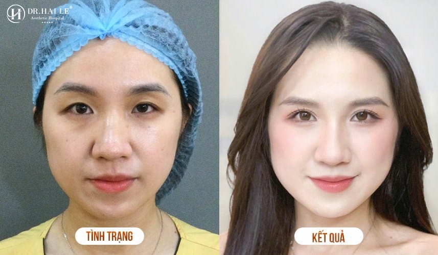 Kết quả cắt mí tại Dr.Hải Lê