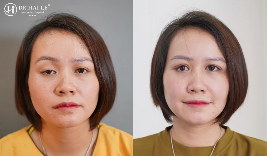 Kết quả sửa mí Dr Hải Lê